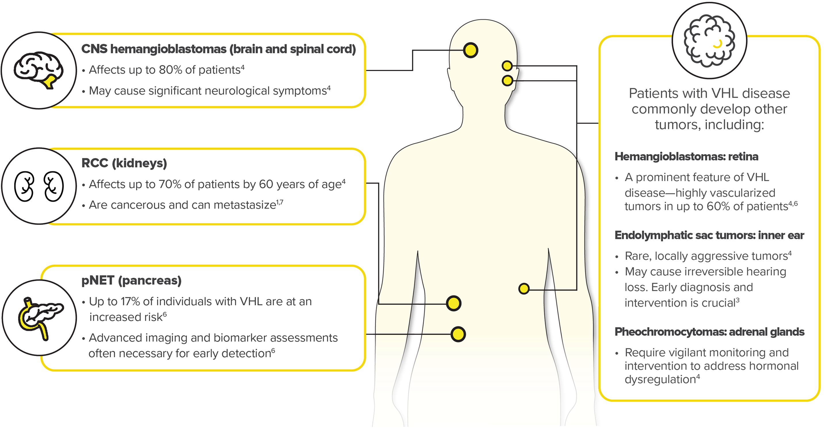 Infographic Showing Potential Sites of Tumor Growth in VHL Disease