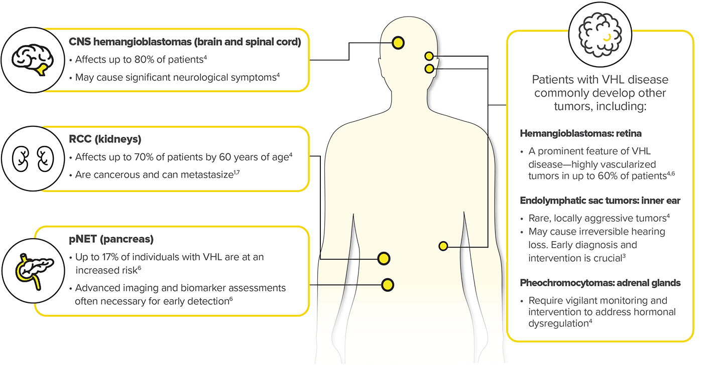 Infographic Showing Potential Sites of Tumor Growth in VHL Disease